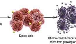 chemotherapy for breast cancer