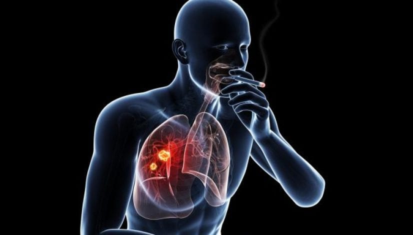 Why don't all smokers get Lung Cancer Treatment
