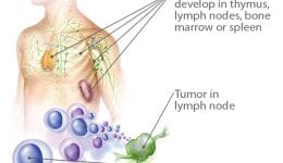 Blood3 Lymphoma – cancer that challenges your immune system