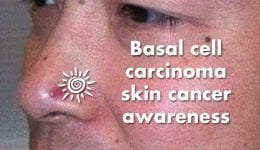 Basal cell cancer symptoms
