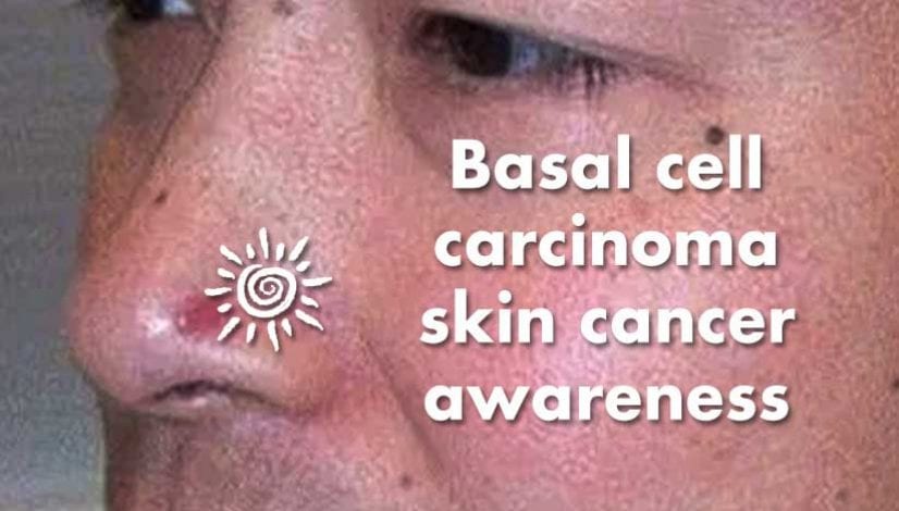 Basal Cell Cancer Symptoms Rash On Nose Positive Bioscience