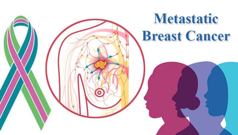 Advances in Metastatic Breast Cancer